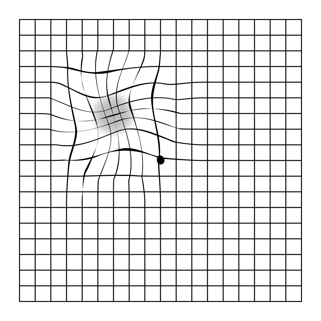 lignes de quadrillage d'amsler distordues