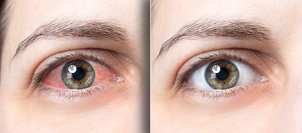 rote Augen vs. gesunde Augen