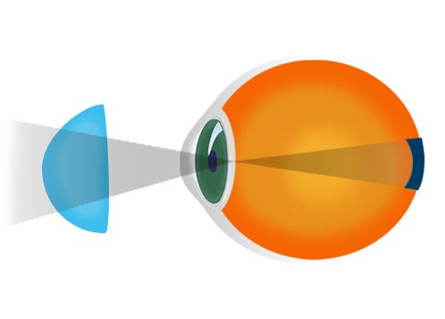 Myopia correction with contact lenses