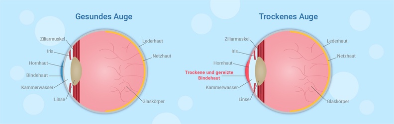 Gesundes Auge vs. Trockenes Auge