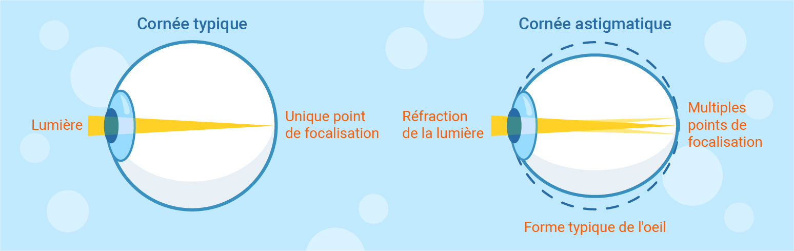 typical and astigmatism cornea