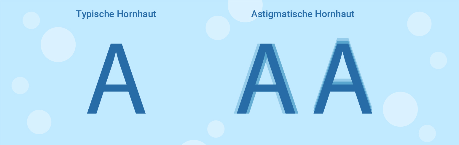 typical and astigmatism cornea